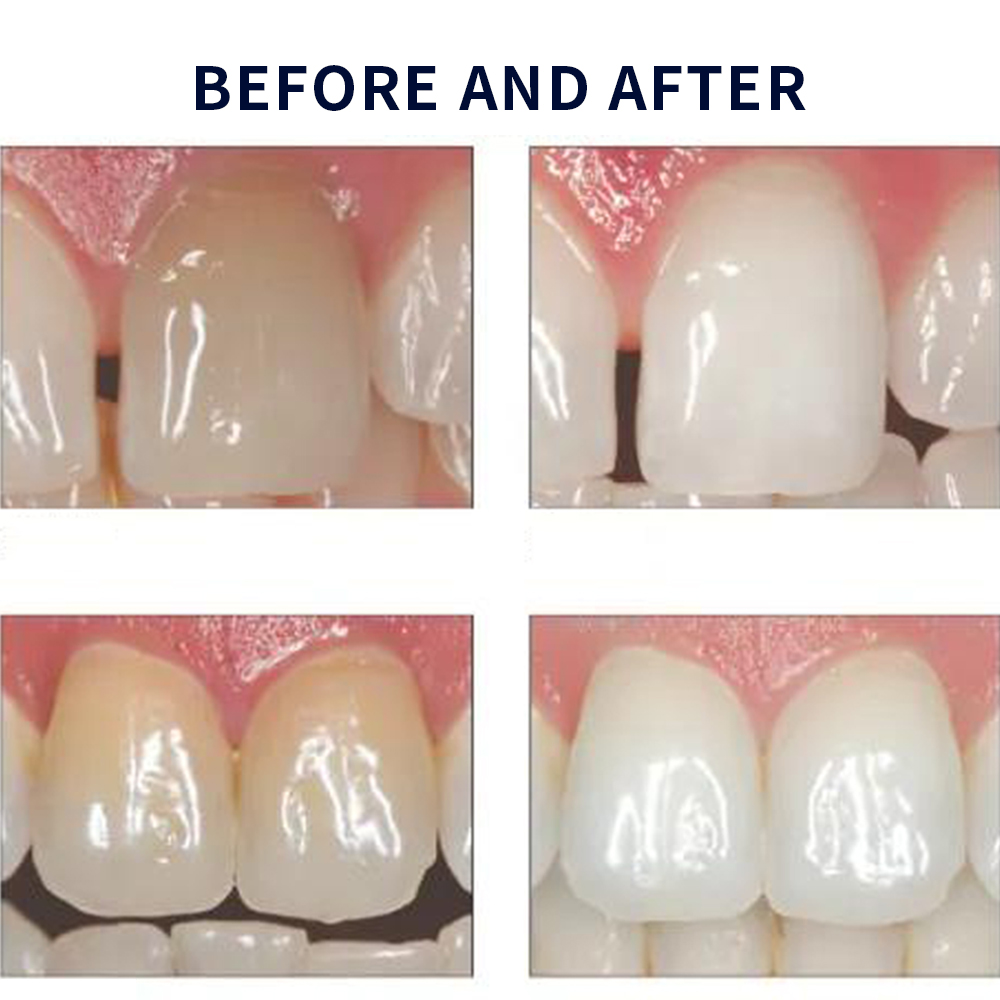 Opalescence beyazlatma 20% PF  - Teeth Whitening Kit incelemesi ve fiyatı