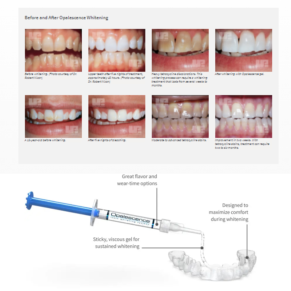 Opalescence beyazlatma 20% PF  - Teeth Whitening Kit incelemesi ve fiyatı